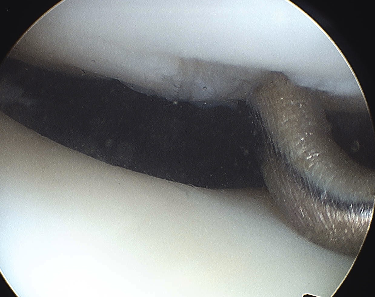 Patella Grade 2 Chondromalaciae